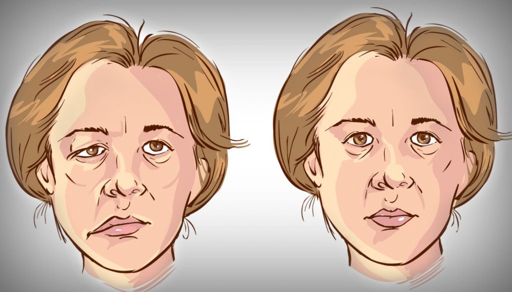 Bell's palsy